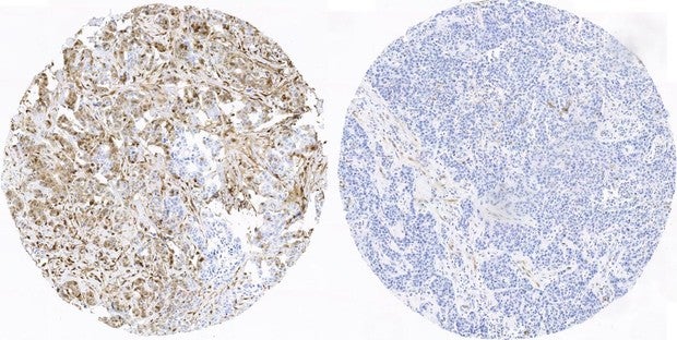 Células cancerígenas