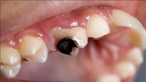 Caries dental