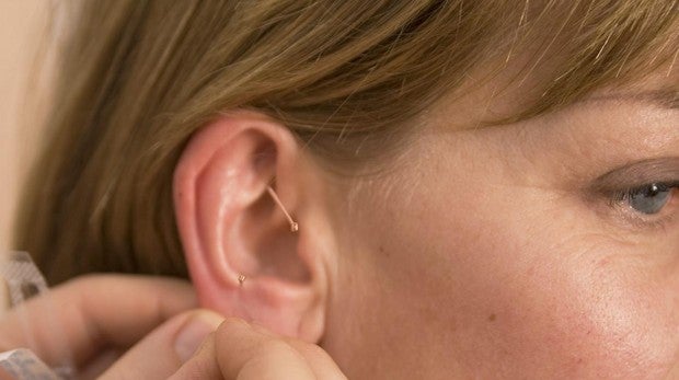 Acupuntura para el dolor