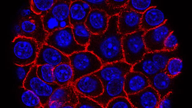 Células de cáncer de páncreas