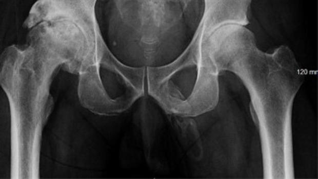 Radiografía que descubrió la osificación del pene de este paciente